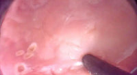 Simulador de Disección submucosa endoscópica ESD endoscopia