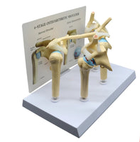 Modelo anatomico degeneracion de hombro osteoartritis