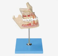 Diente Patológico de Mandíbula Modelo de Dientes tamaño real