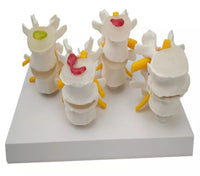 Modelo anatómico degeneracion lumbar vertebras