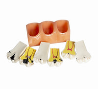 Modelo de Caries Modelo de Descomposición de Caries