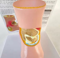 Artritis pie de gota