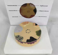 Modelo cancer de piel carcinoma