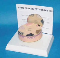 Modelo cancer de piel carcinoma