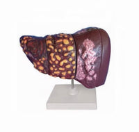 Modelo Cancer de Hígado