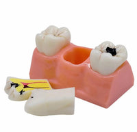 Modelo de Caries Modelo de Descomposición de Caries