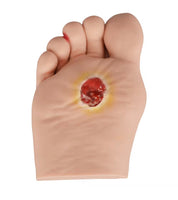 Modelo Pie Diabetico 5 Etapas