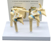 Modelo anatomico degeneracion de hombro osteoartritis
