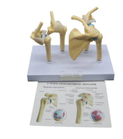 Modelo anatomico degeneracion de hombro osteoartritis
