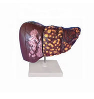 Modelo Cancer de Hígado