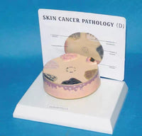 Modelo cancer de piel carcinoma