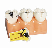 Modelo de Caries Modelo de Descomposición de Caries