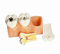 Modelo de Caries Modelo de Descomposición de Caries