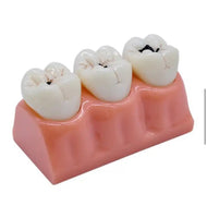 Modelo de Caries Modelo de Descomposición de Caries