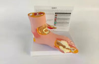 Artritis pie de gota