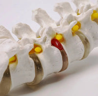 Modelo anatomico de columna vertebral humana con hernia discal