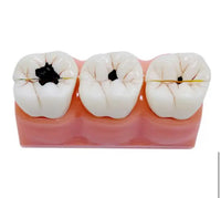 Modelo de Caries Modelo de Descomposición de Caries