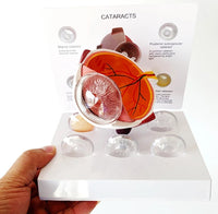 Modelo Anatomico Cataratas