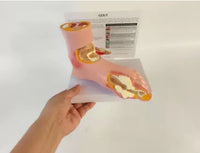 Artritis pie de gota