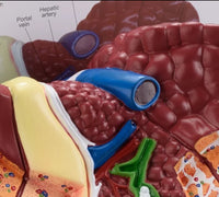 modelo anatomico Higado patologico detallado