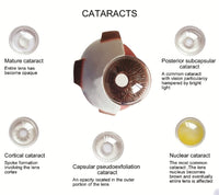 Modelo Anatomico Cataratas