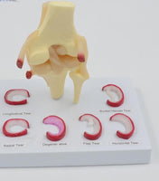 Modelo Anatomico de rodilla - meniscos traumatologia