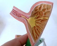 Modelo de estomago reflujo gastrico Patologia gastrica