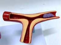 Modelo de corazon trombosis Vascular con arteria