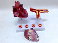Modelo de corazon trombosis Vascular con arteria