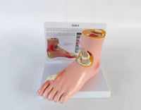 Artritis pie de gota