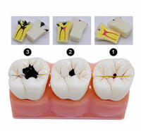 Modelo de Caries Modelo de Descomposición de Caries