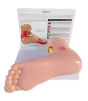 Artritis pie de gota