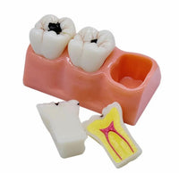 Modelo de Caries Modelo de Descomposición de Caries