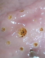 Simulador de Disección submucosa endoscópica ESD endoscopia