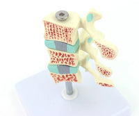 Anatomia osteoporosis intra-vertebral.