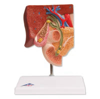 Modelo de cálculos biliares - Alta Simulacion