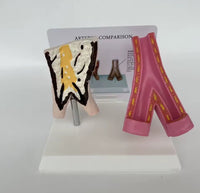 Modelo anatómico Arterias vasculares comparación aterosclerosis