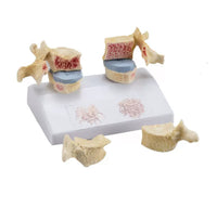 Modelo de osteoporosis de la columna vertebral humana - Alta Simulacion