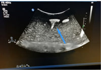 Simulador ultrasonido tumores de mama puncion pecho biopsia