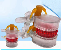 Modelo de vertebra lumbar - hernia discal - Modelos Anatómicos Humanos