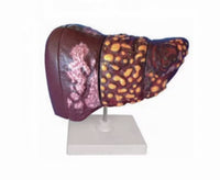 Modelo Cancer de Hígado