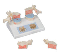 Modelo de osteoporosis de la columna vertebral humana - Alta Simulacion