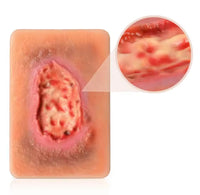 Modelo Kit de heridas necroticas