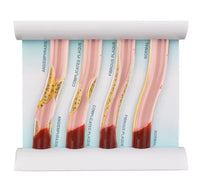 Simulador Arterial LDL colesterol obstruccion flujo sanguíneo