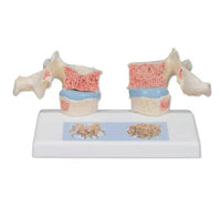 Modelo de osteoporosis de la columna vertebral humana - Alta Simulacion