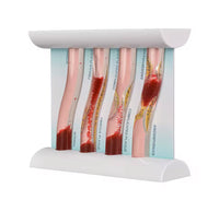 Simulador Arterial LDL colesterol obstruccion flujo sanguíneo