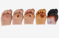 Modelo Pie Diabetico 5 Etapas