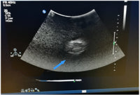 Simulador ultrasonido tumores de mama puncion pecho biopsia