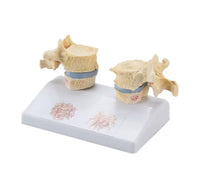 Modelo de osteoporosis de la columna vertebral humana - Alta Simulacion