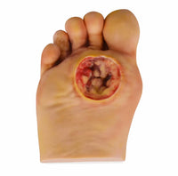 Modelo Pie Diabetico 5 Etapas